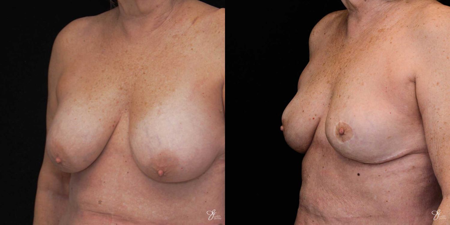 Breast Implant Removal With Lift Before & After