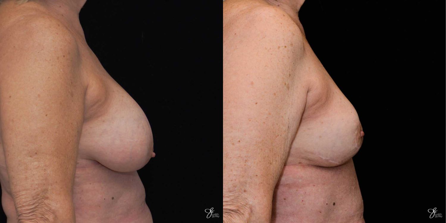 Breast Implant Removal With Lift Before & After