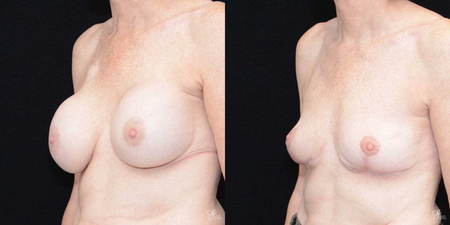 Breast Implant Removal With Lift Before & After