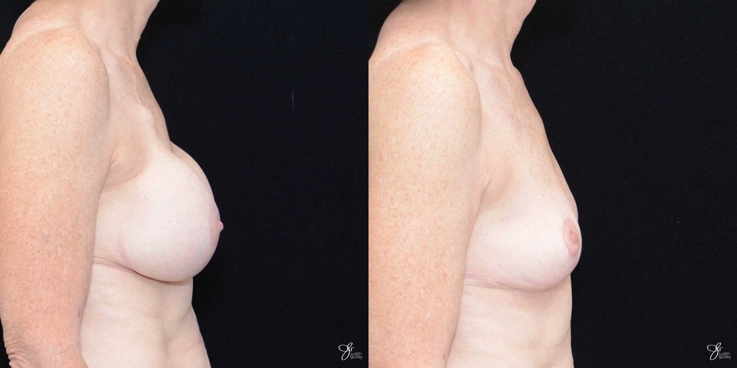 Breast Implant Removal With Lift Before & After