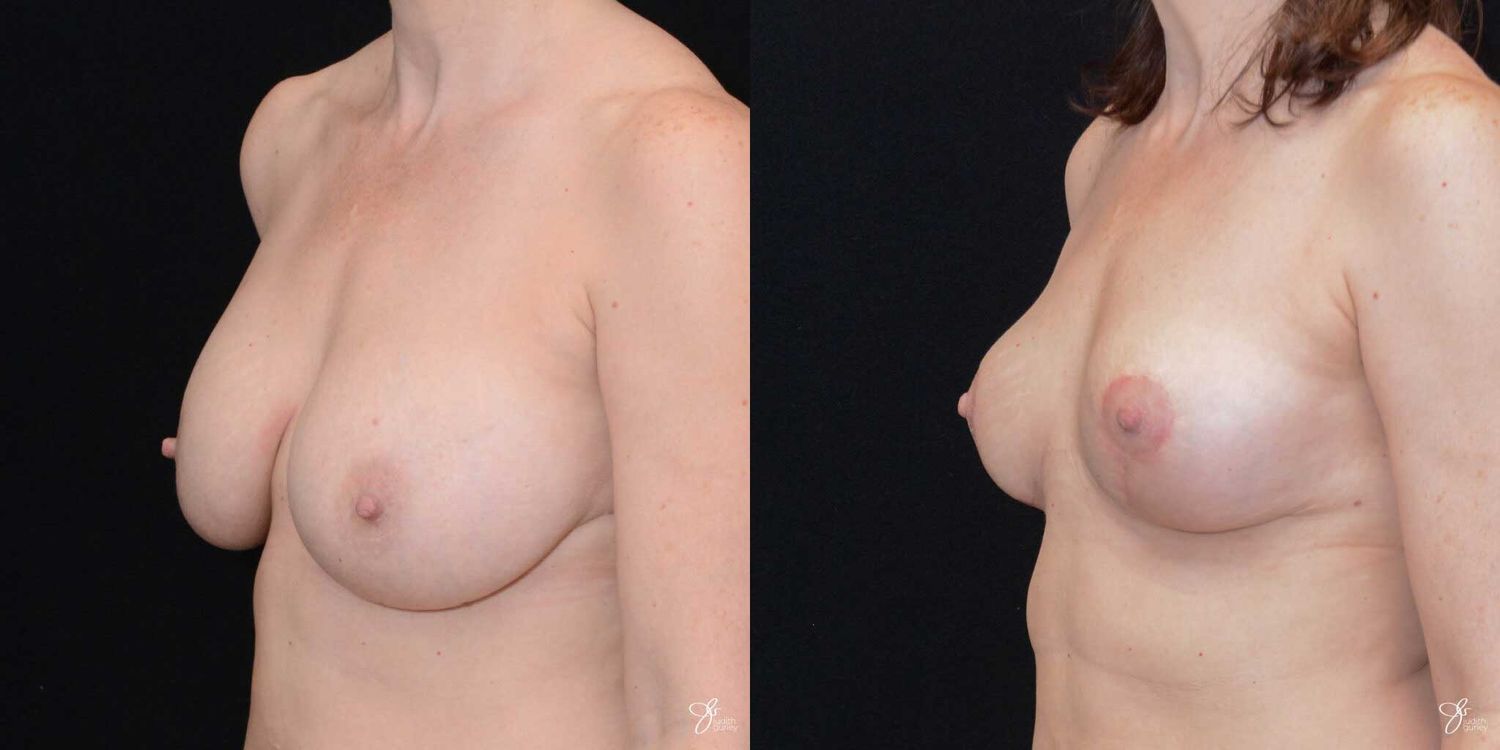 Breast Implant Removal With Lift Before & After