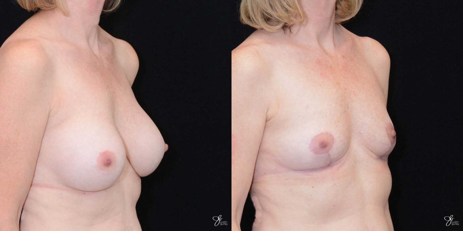 Breast Implant Removal With Lift Before & After