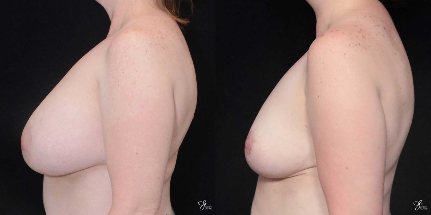 Breast Implant Removal With Lift Before & After