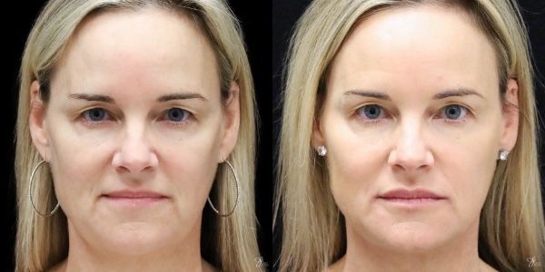 Facial Filler Before & After