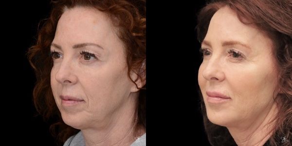Facial Filler Before & After