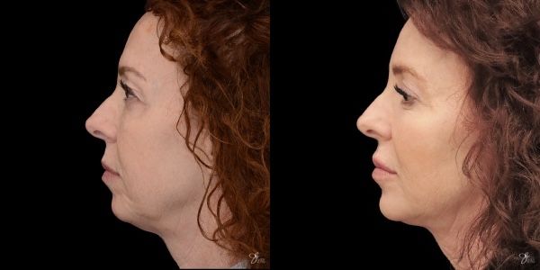 Facial Filler Before & After