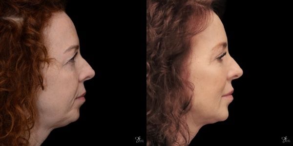 Facial Filler Before & After