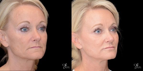 Facial Filler Before & After