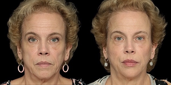 Facial Filler Before & After
