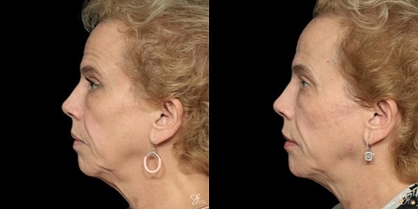 Facial Filler Before & After