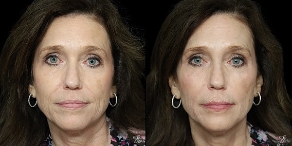 Facial Filler Before & After