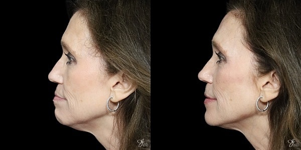 Facial Filler Before & After