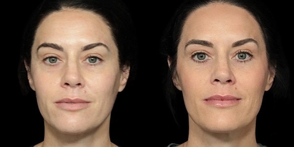 Facial Filler Before & After