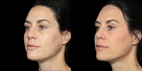 Facial Filler Before & After