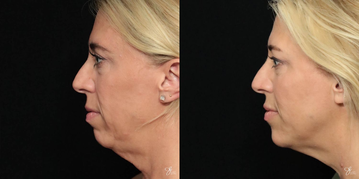 Facial Filler Before & After