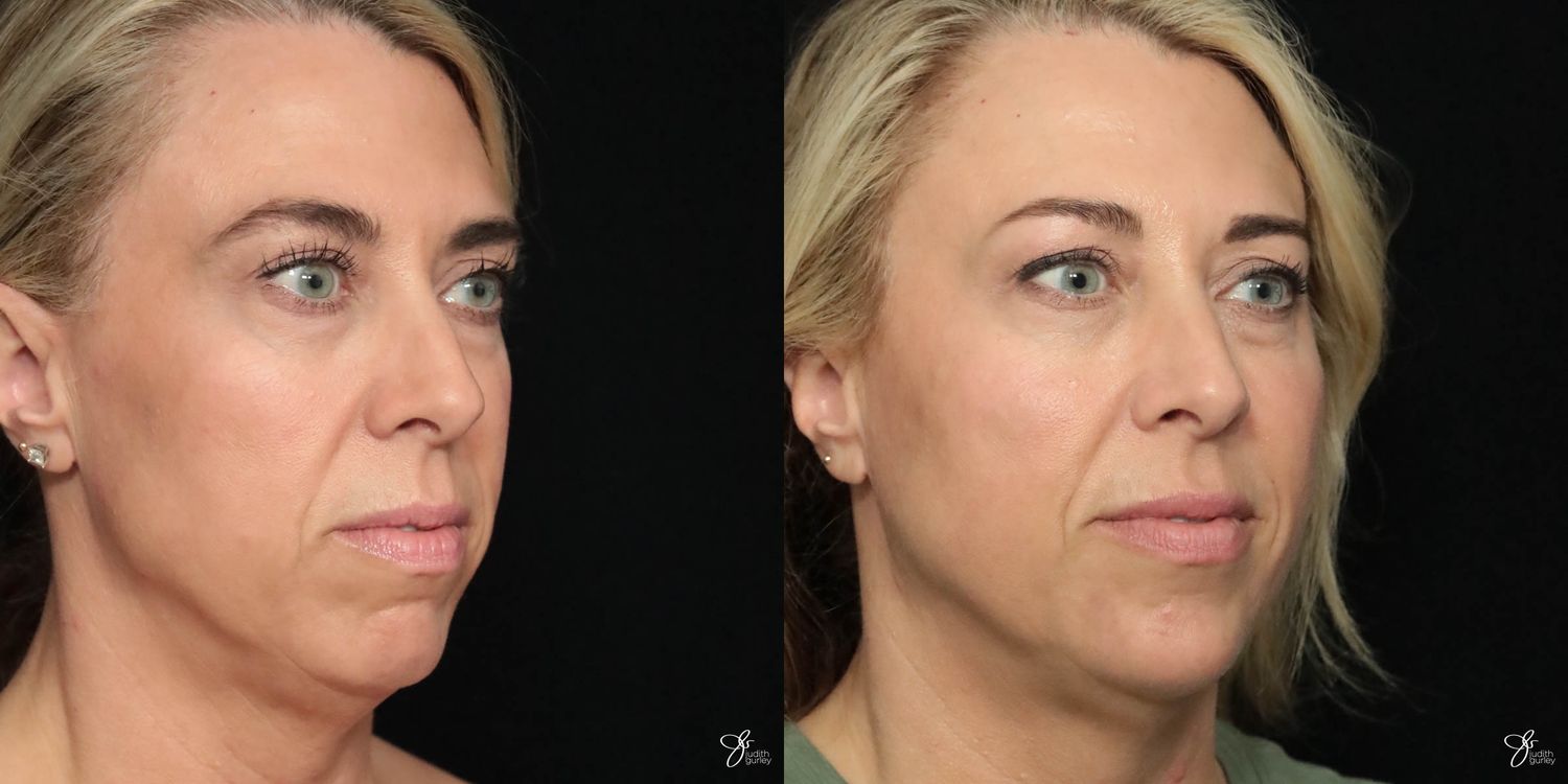 Facial Filler Before & After
