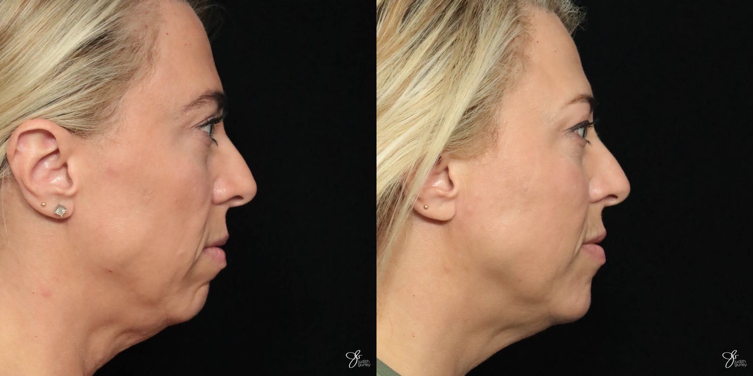 Facial Filler Before & After