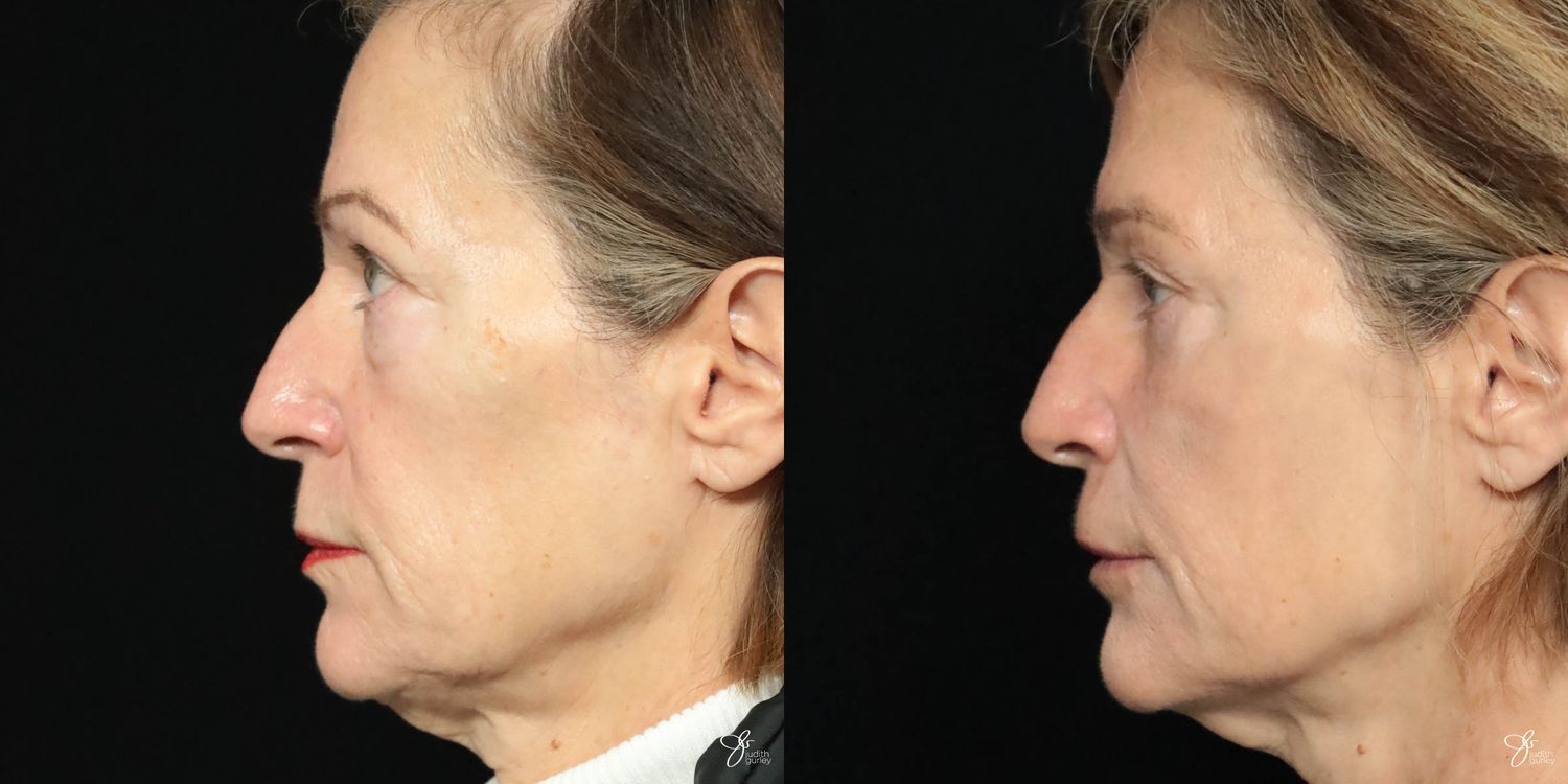 Facial Filler Before & After