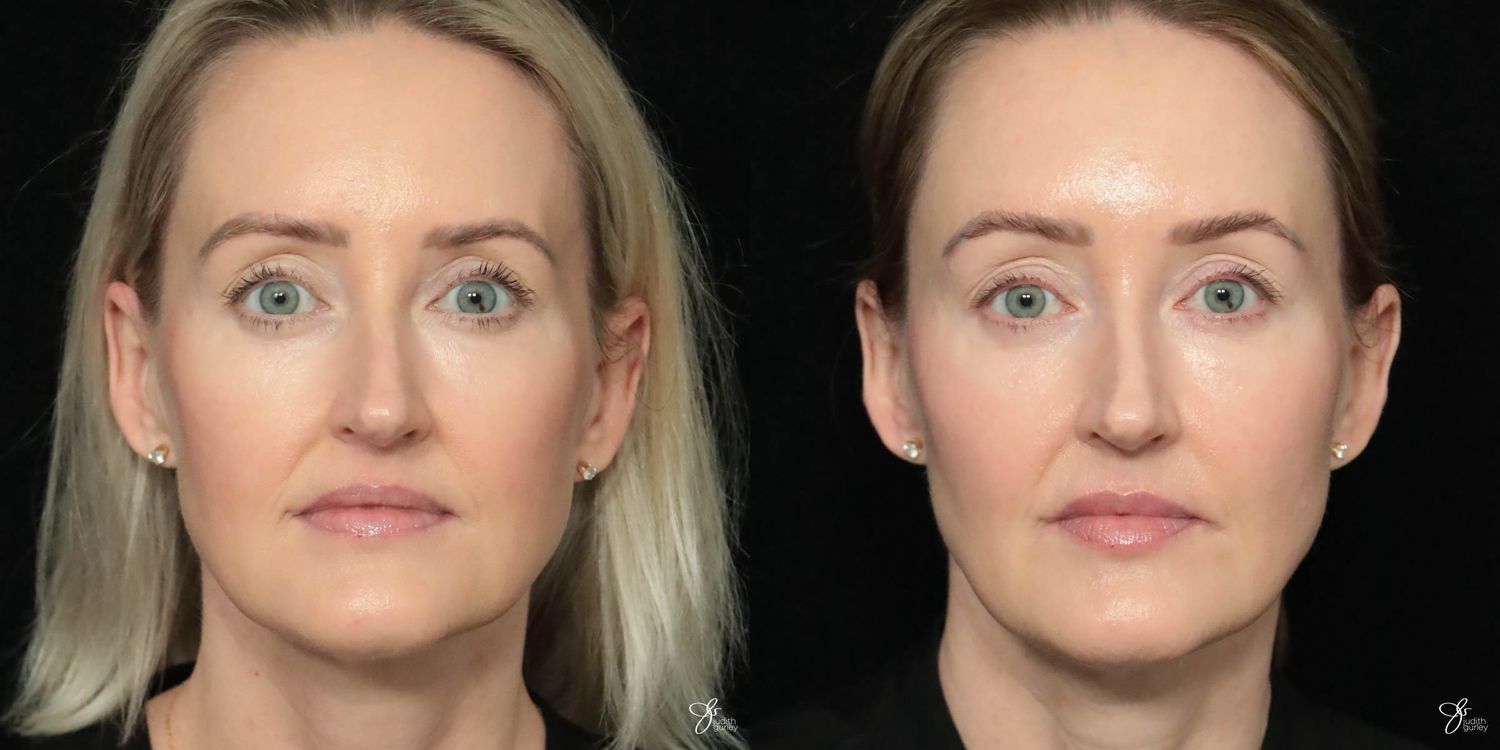 Facial Filler Before & After