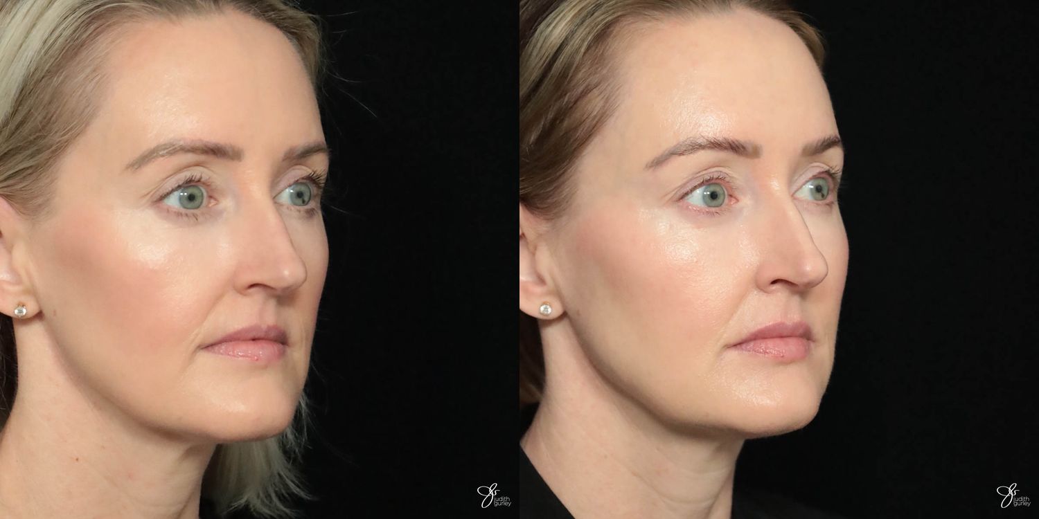 Facial Filler Before & After