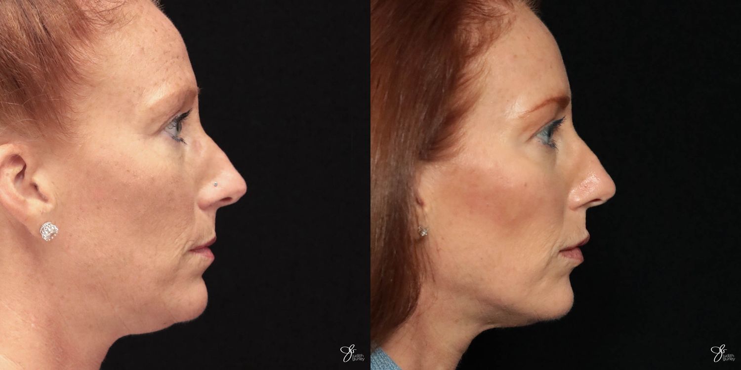 Facial Filler Before & After