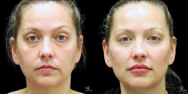 Facial Filler Before & After