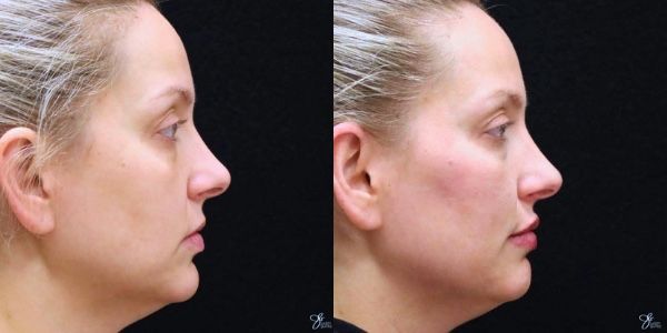 Facial Filler Before & After