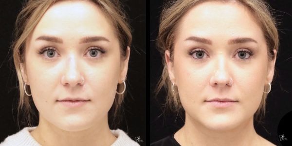 Facial Filler Before & After