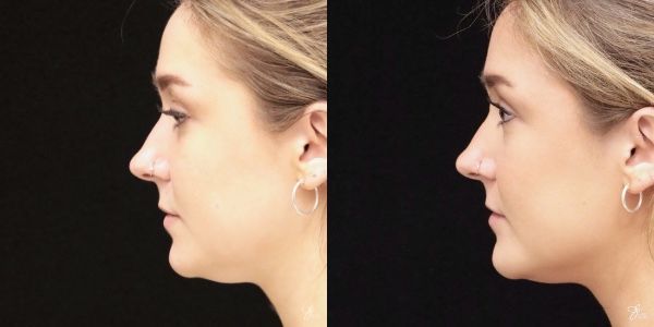 Facial Filler Before & After