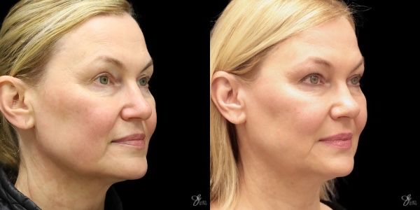 Facial Filler Before & After