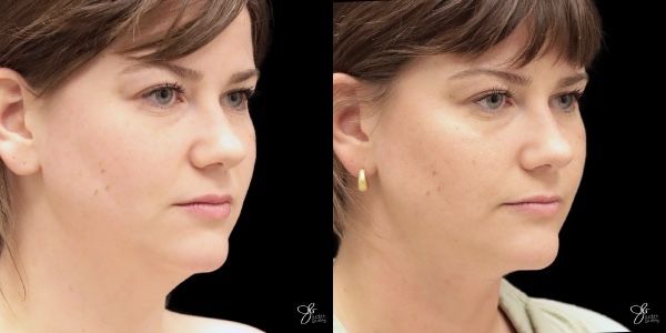 Facial Filler Before & After