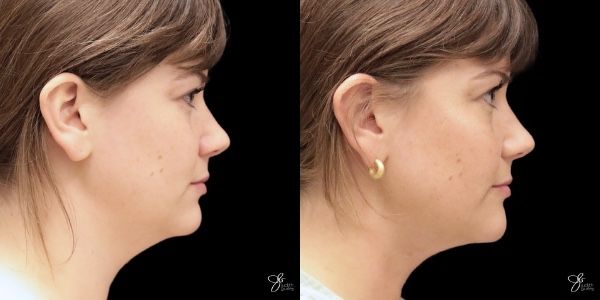 Facial Filler Before & After