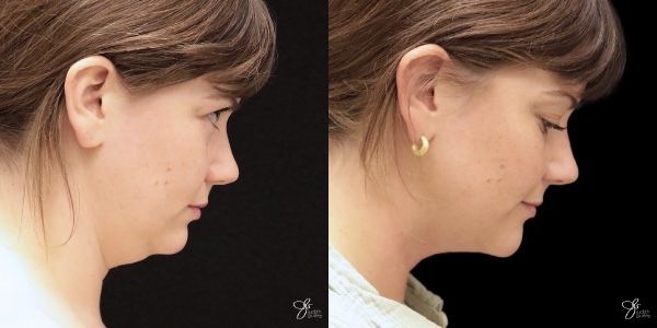 Facial Filler Before & After