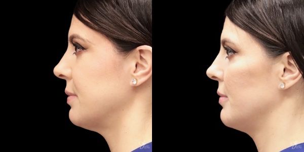 Facial Filler Before & After