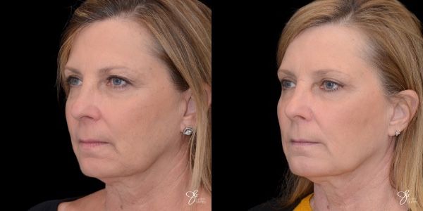 Facial Filler Before & After