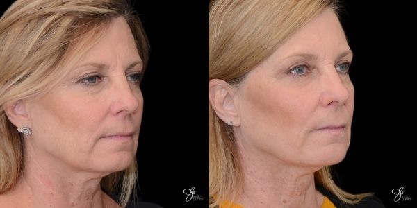 Facial Filler Before & After