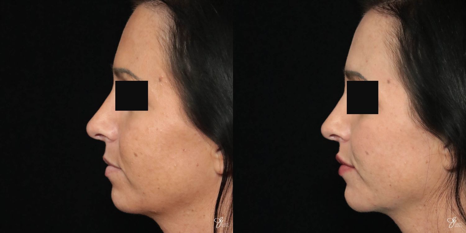 Facial Filler Before & After