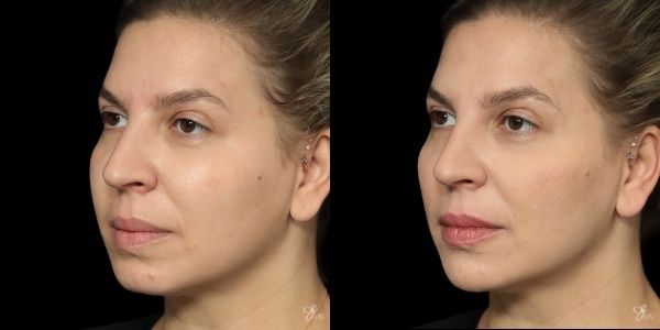 Facial Filler Before & After