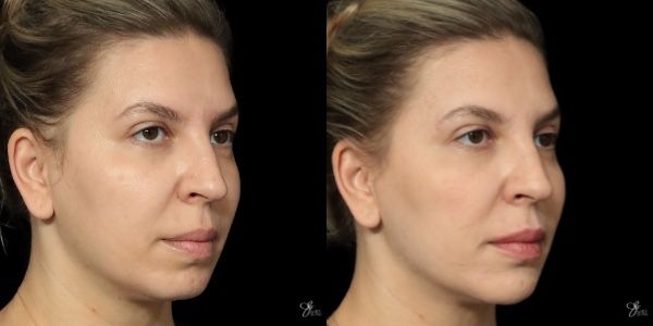Facial Filler Before & After