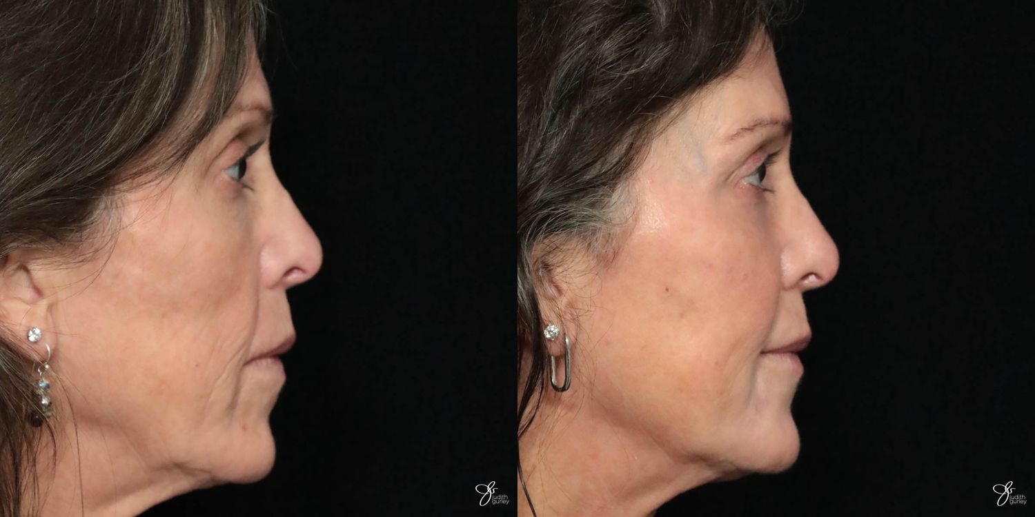 Facial Filler Before & After