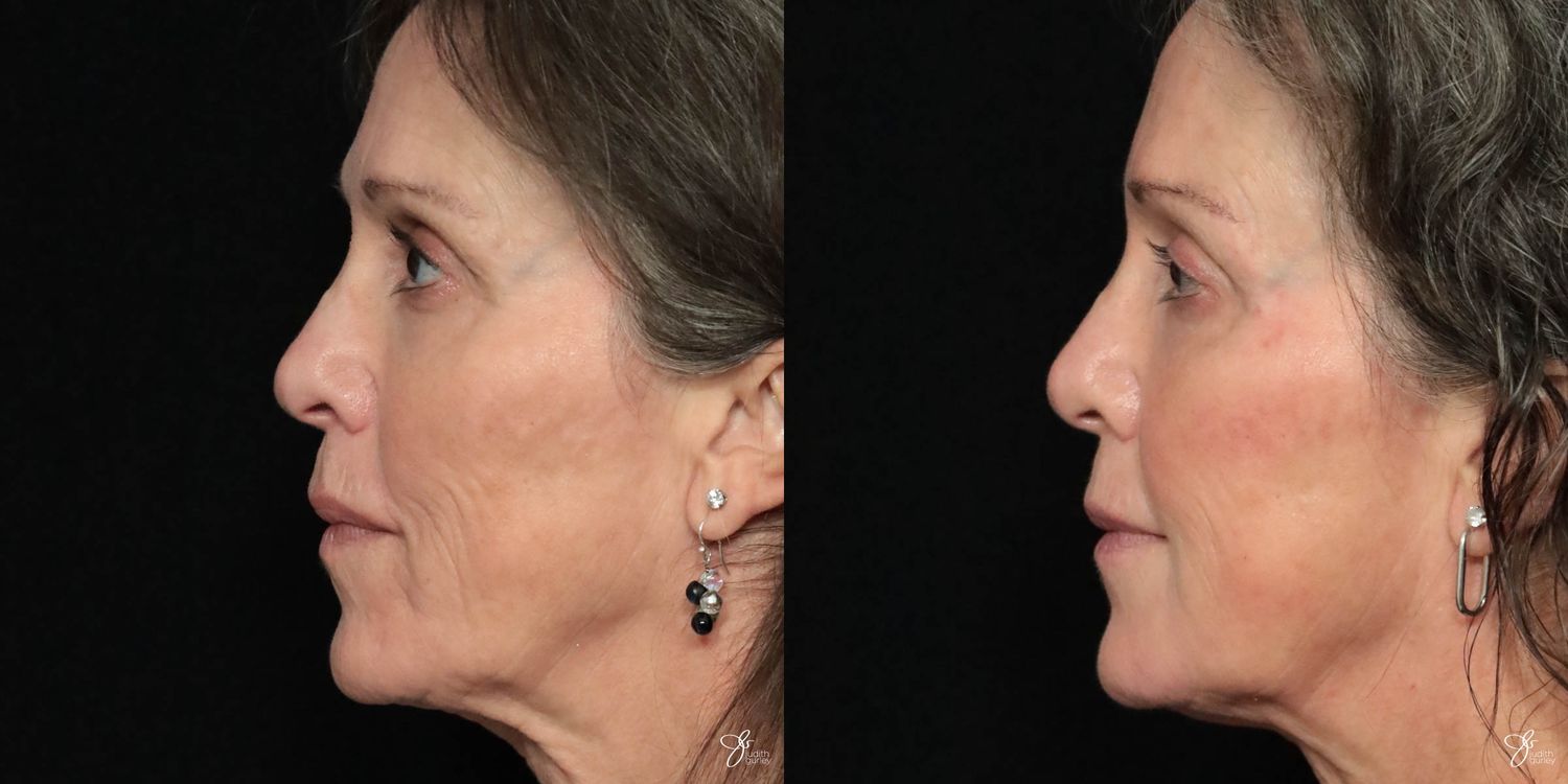 Facial Filler Before & After