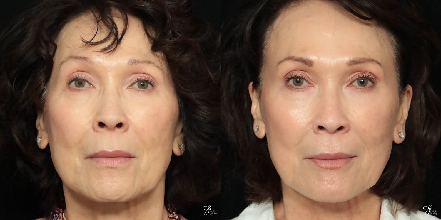 Facial Filler Before & After