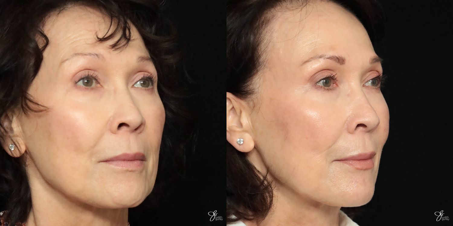 Facial Filler Before & After