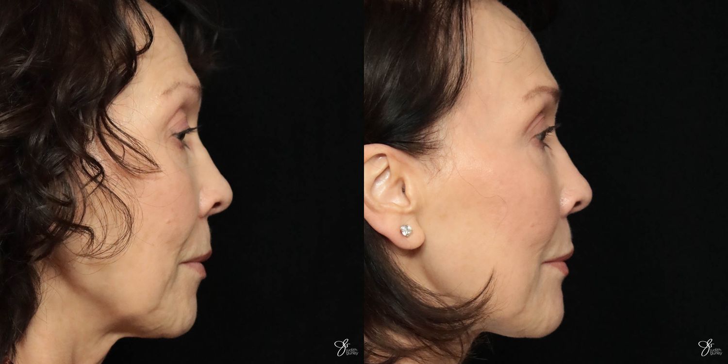 Facial Filler Before & After