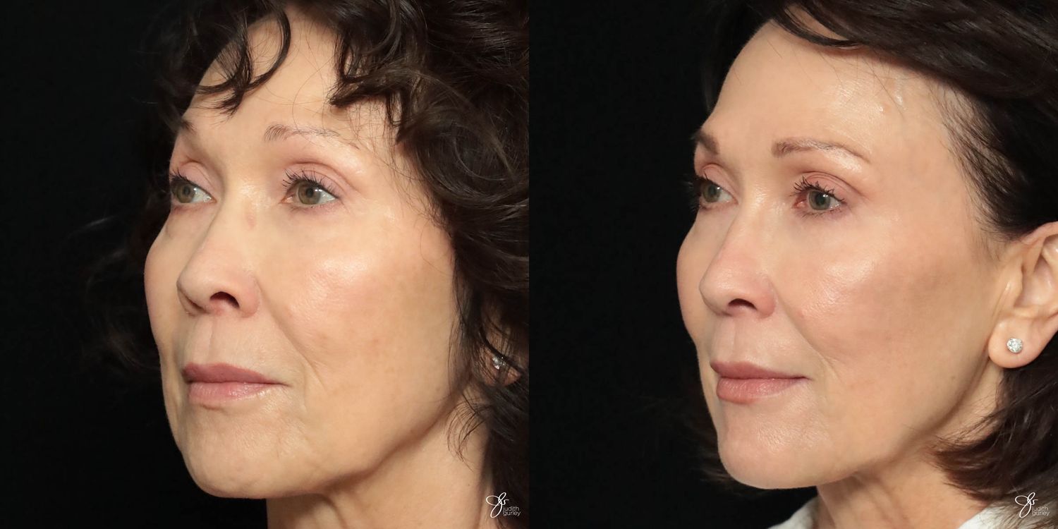 Facial Filler Before & After