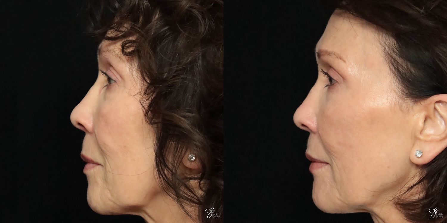 Facial Filler Before & After