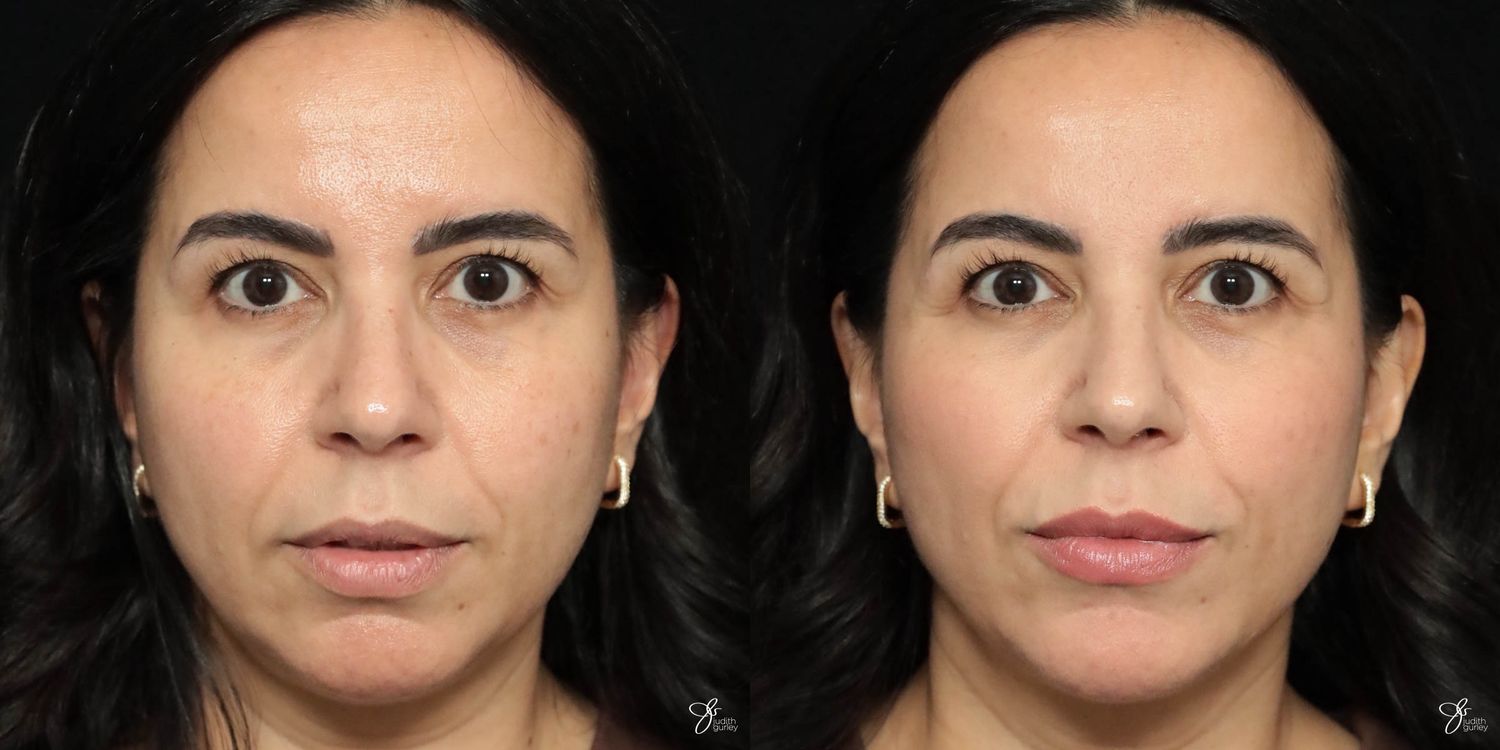 Facial Filler Before & After