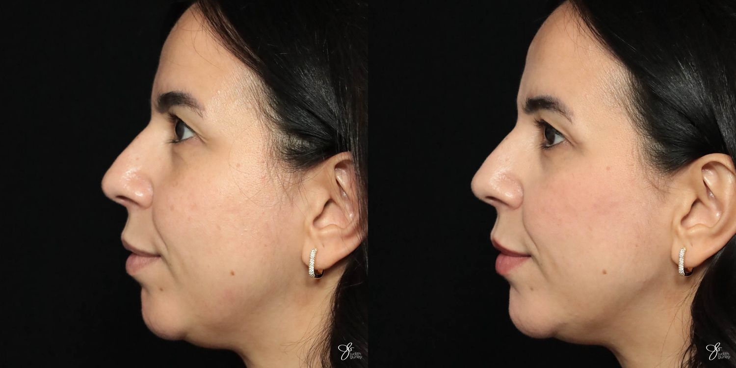 Facial Filler Before & After