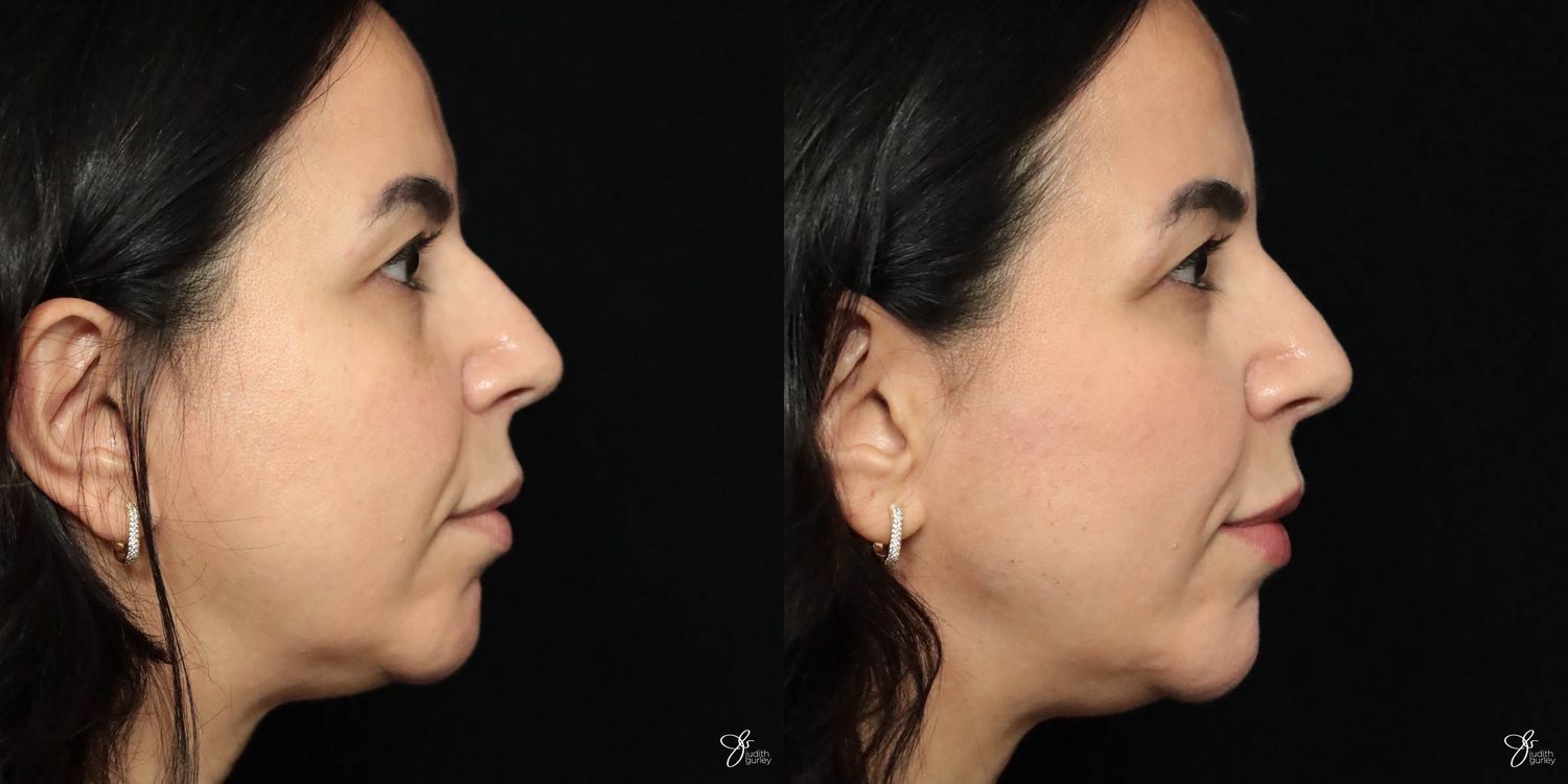 Facial Filler Before & After