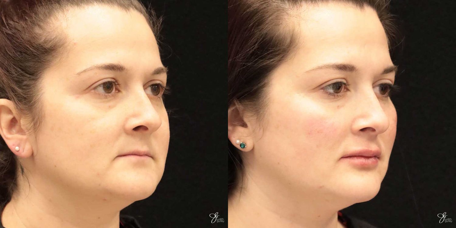 Facial Filler Before & After